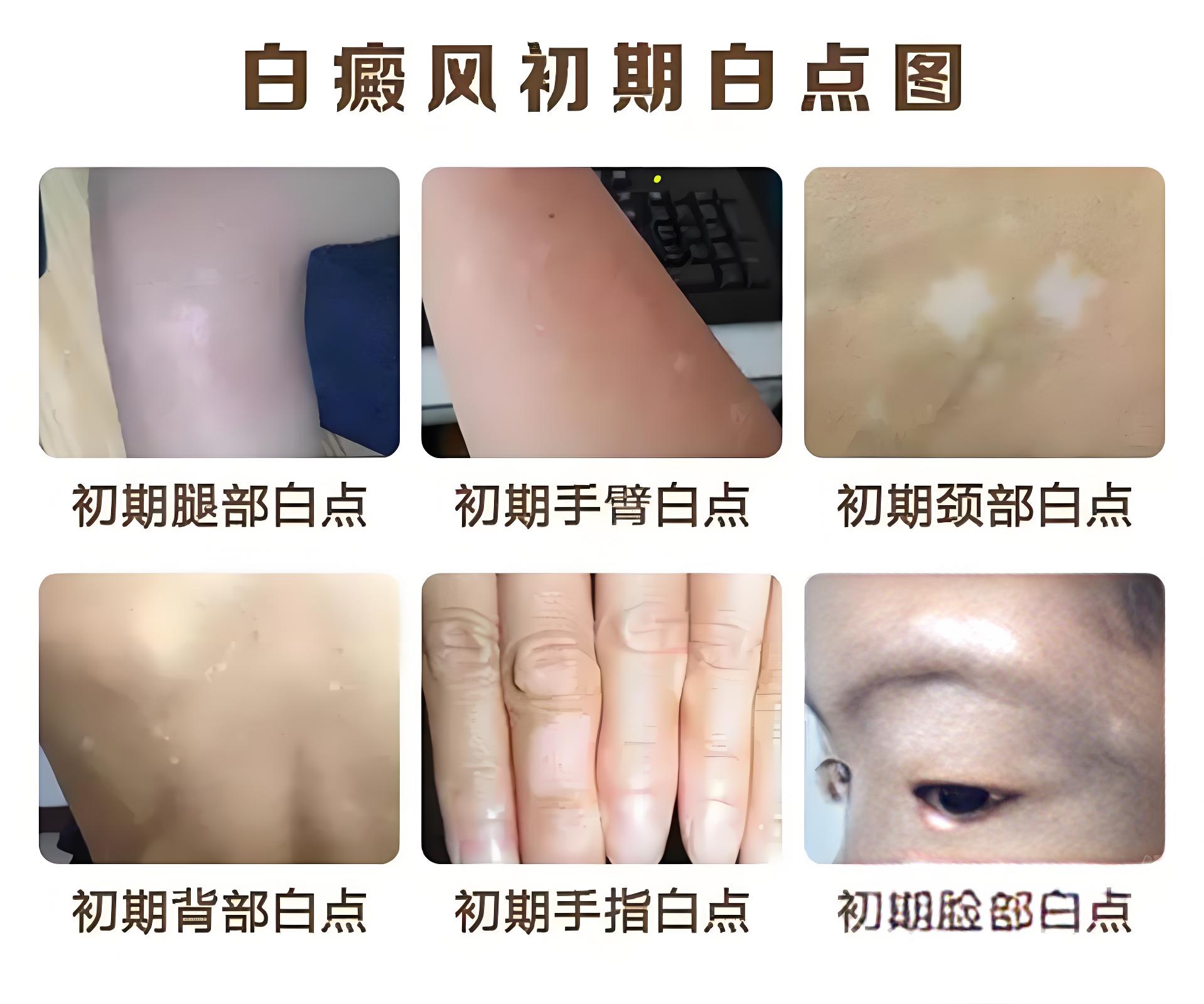 近期重點(diǎn)-泉州哪一家白癜風(fēng)醫(yī)院好？白癜風(fēng)初期癥狀圖片大全？