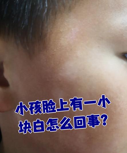 [新趨勢]泉州正式白癜風治療醫院？小孩臉上白斑摸上去粗糙？